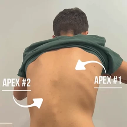 Chiropractic-Redondo-Beach-CA-Scoliosis Chiropractic-Redondo-Beach-CA-Scoliosis